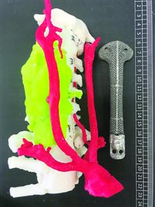 她的脖子是3D打印出来的|假体|软骨肉瘤|人工