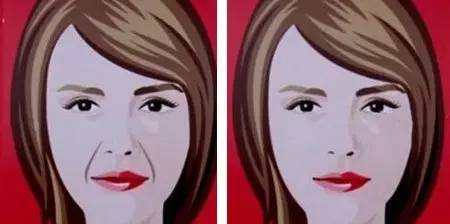 自体脂肪填充 | 告别法令纹,挽回逝去的青春|自