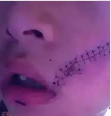 可乐冷冻后成炸弹,男孩脸部缝38针!这些千万