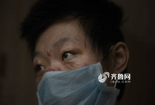  “孩子的毛孔烧没了，一点热气也不能受。”江竹峰说