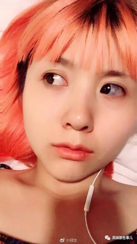 胎记长在了眼球上!影响视力吗?这姑娘被各种网
