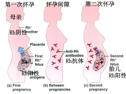 新生儿溶血性贫血（图片来源：Quora）