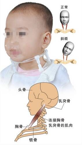 痉挛性斜颈总“歪脖子”？吃对了能帮着放松肌肉～附饮食清单??