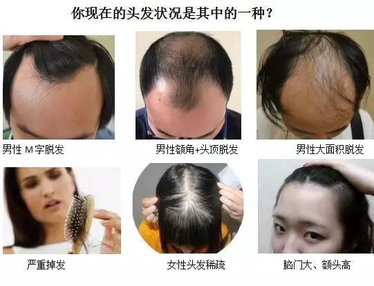 【推介】秃顶、发际线高、头顶稀疏困扰那么多