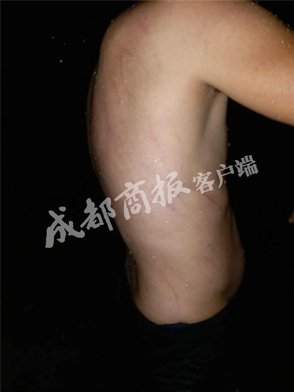 被救男子身上的抓痕。