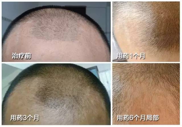 治疗脱发、秃顶,到底是药物好还是植发对?正确