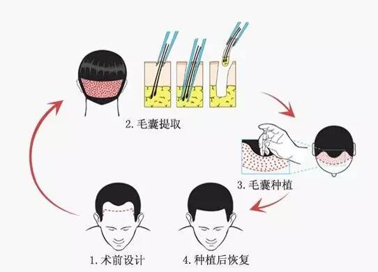 治疗脱发、秃顶,到底是药物好还是植发对?正确