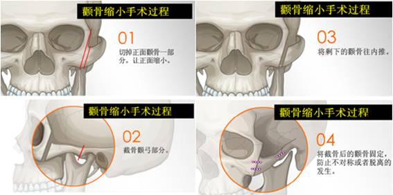 【太阳穴凹陷】+【颧骨外扩】最强非手术拯救