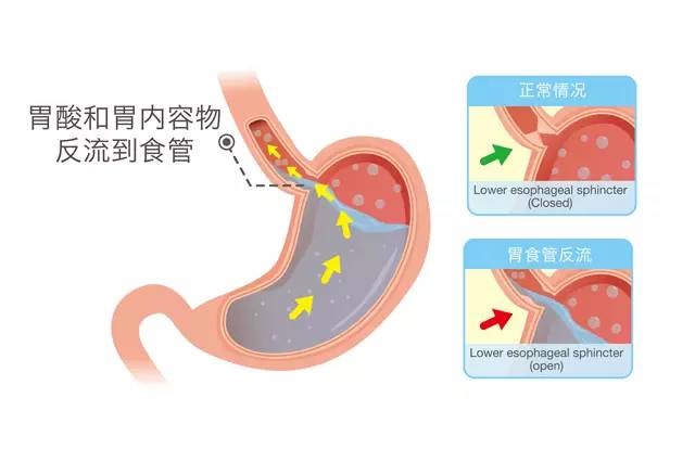 不仅烧心反酸,这种胃病的杀伤力比你想的还凶