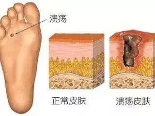 剪了剪脚上的老茧,竟然要截趾保命?医生:这个