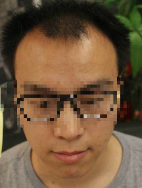 差别这么大?一个像大叔,一个小鲜肉!|脱发|毛