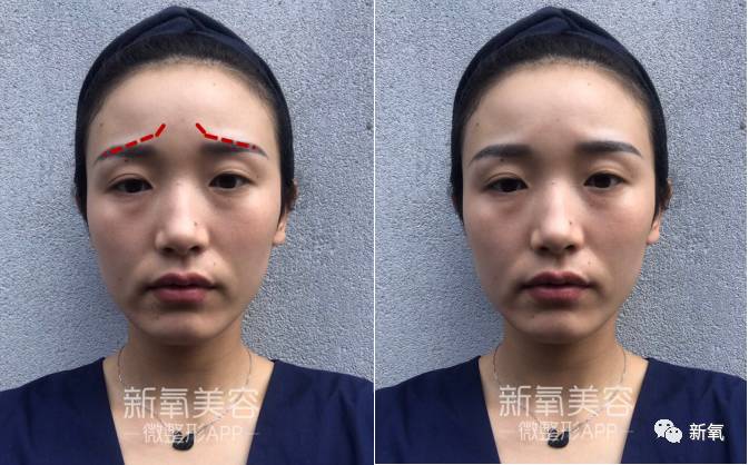 瘦脸针,除皱针那个针,在眉头和眉上位置,让这里的皱眉肌松弛平缓下来