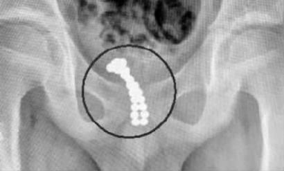 11岁男童将26颗磁珠塞进小鸡鸡…
