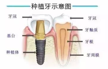 种植牙10项费用全额补贴,50颗免费种植体微信