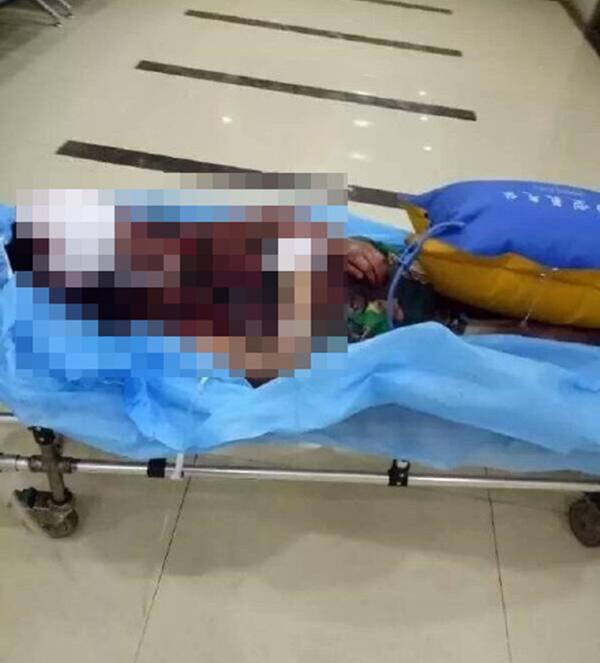 重症监护室病床上的受害者。 @红星新闻 图