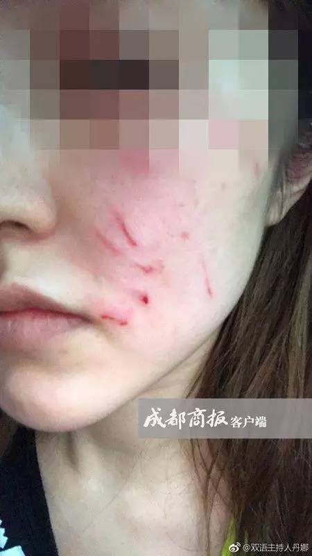 美女主持自曝遛狗未拴绳遭暴打，半边脸“毁容”，网友吵翻了