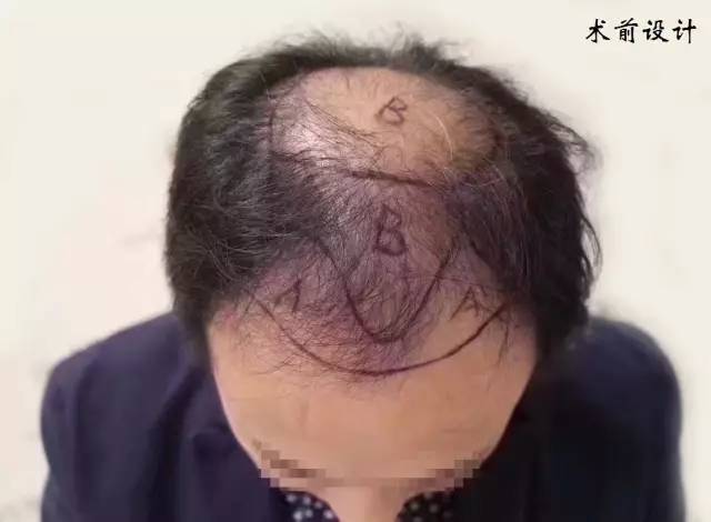 脱发、秃顶、疤痕缺发、眉毛稀缺?这家三级医