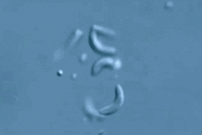 脑袋里被挖了多条“隧道”，广州医院从12岁女孩头部取出25厘米寄生虫!太吓人了|寄生虫|婷婷|小芸_新浪新闻