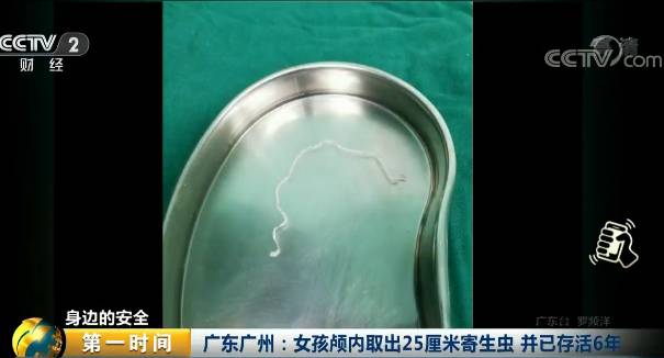 提醒女孩颅内取出25厘米寄生虫或因这个习惯患病