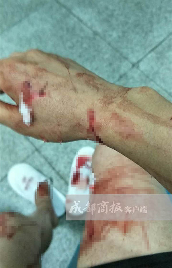 浴室玻璃门碎裂,女子手足多处肌腱损伤