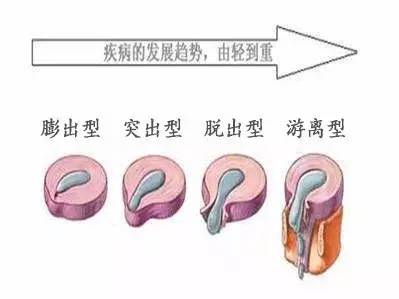 椎间盘突出、腰疼、下肢痛麻、颈椎疼怎么办?只需一招，轻松告别骨痛折磨|肩周炎|椎间盘|消痛贴_新浪新闻