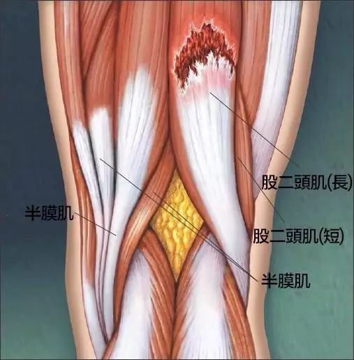 肌肉为何会拉伤的 5 个原因|肌肉|运动|大腿_新浪新闻