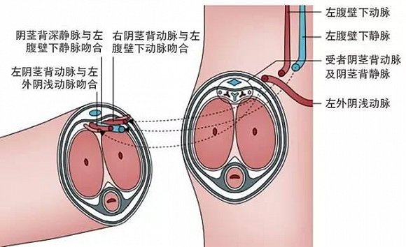 全球首例成功阴茎移植 男子两年恢复正常性生活(组图) - 2