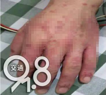 购面膜治痘,用了两次全身长红疹水泡!连私处都