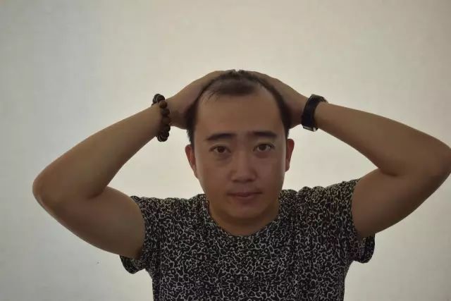 你也有困扰?脱发、秃顶、眉毛稀缺,免费植发你