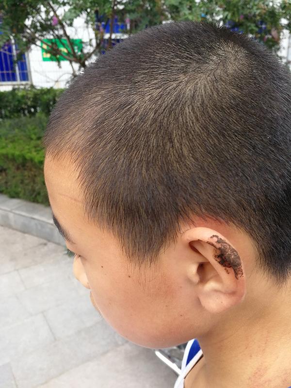 陕西宝鸡一中学140名师生上学途中被野蜂蜇伤