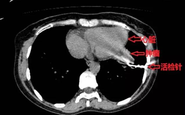 十字会医院完成一例高难度CT引导下经皮肺占