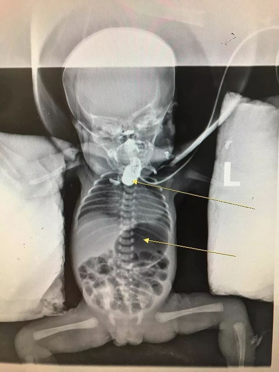 宝宝像螃蟹一样吐泡泡?警惕!医生:这个病不及