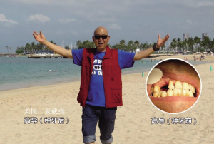 专家提醒:缺牙危害大,种牙需及时|缺牙|假牙|口