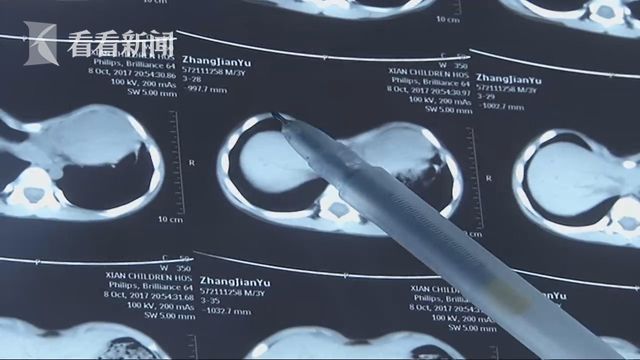 视频|三岁男童被误诊为佝偻病 错误补钙两年查