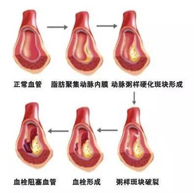 室一族赶紧注意啦!久坐不动,当心下一个血栓患