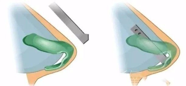 【整外干货】自体软骨隆鼻|隆鼻|整形|三角_新浪女性_新浪网