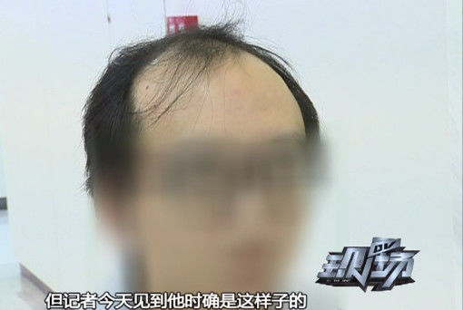 小伙因为长期做这件事 35岁成“地中海”|脱发|头发|地中海_新浪新闻