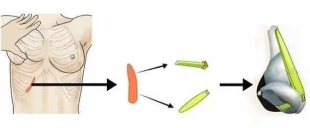 【整外干货】自体软骨隆鼻|隆鼻|整形|三角