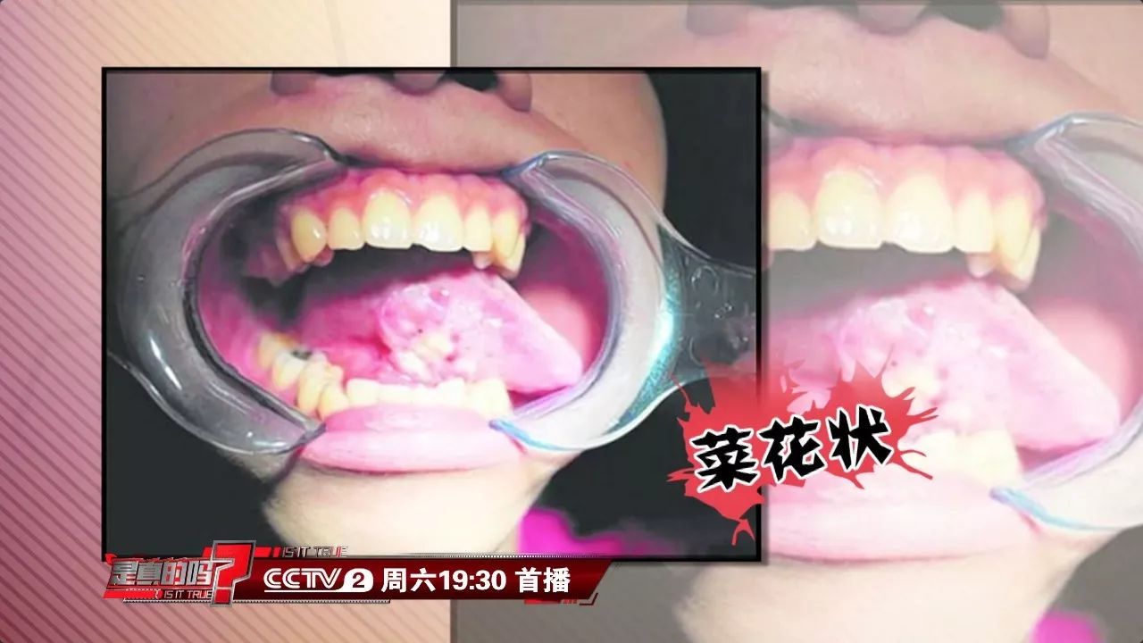 看看,这个可能是癌症信号!千万别大意→|口腔溃