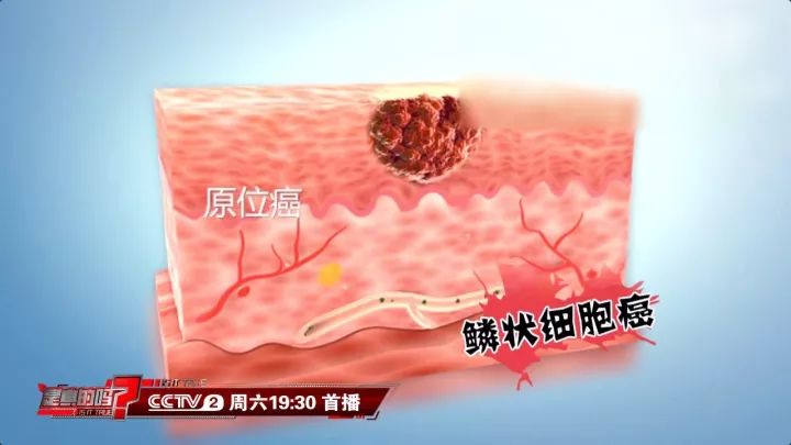 嘴看看,这个可能是癌症信号!千万别大意|口腔溃