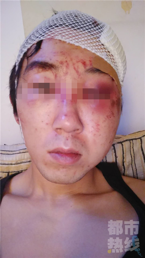 　應(yīng)屆畢業(yè)生西安街頭莫名被群毆，頭上縫了十幾針。