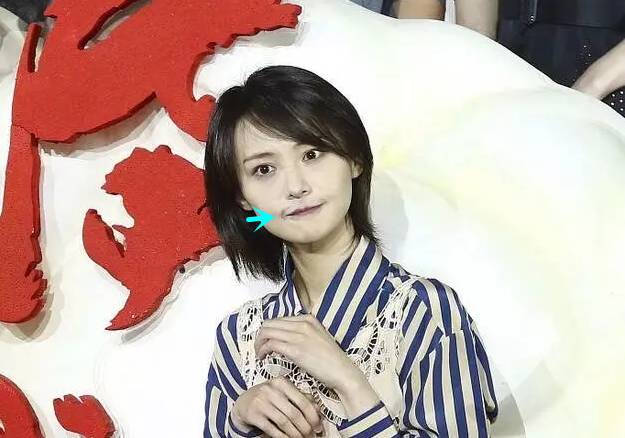 郑爽嘴角的疤痕疑似做嘴角上扬术?可微笑唇不