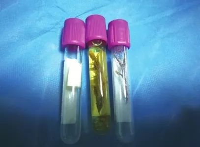 惊呆!成都4岁男孩咳嗽咯血长达一年!竟在支气