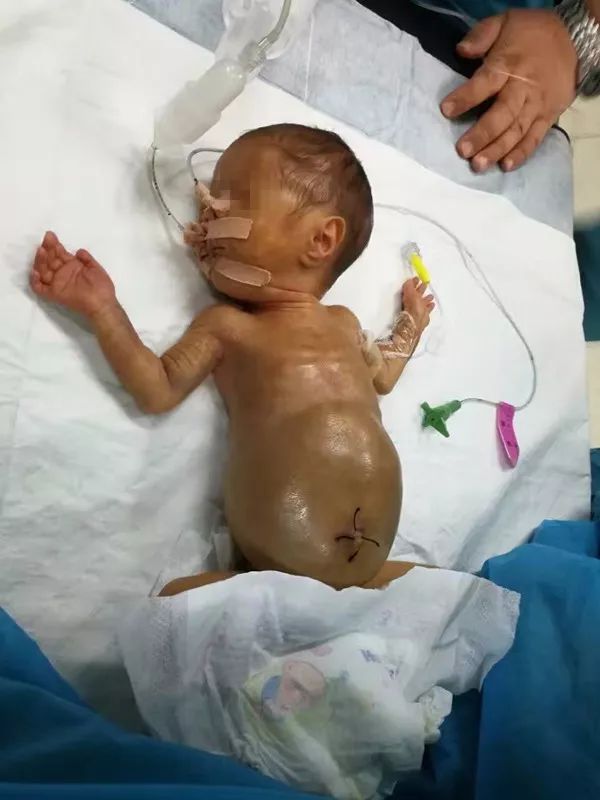 脑瘤产妇生下巴掌女婴,母女同闯生死关,奇迹康复!感恩母爱的伟大,更要感谢父亲的坚忍…|郭艳|恩恩|脑瘤_新浪新闻