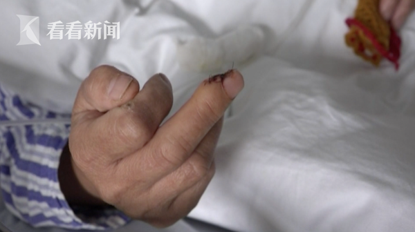 视频|吓人!家庭主妇伤口感染形成黑洞 凶手