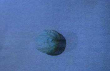 当心!24岁女子喝水喝出急性腰扭伤!这个病已经