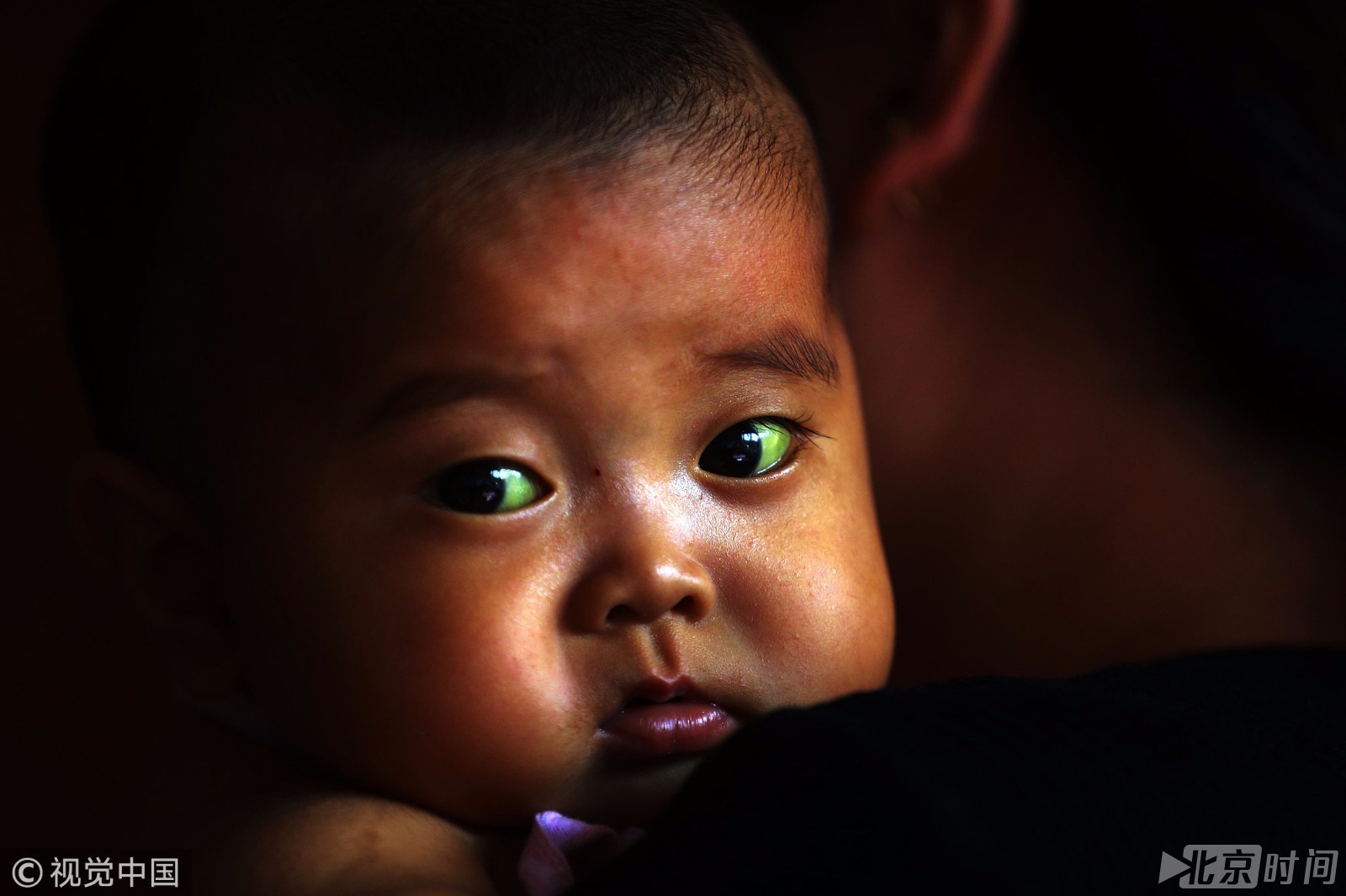 长春一幼童眼睛变绿色 妈妈朋友圈记满孩子求