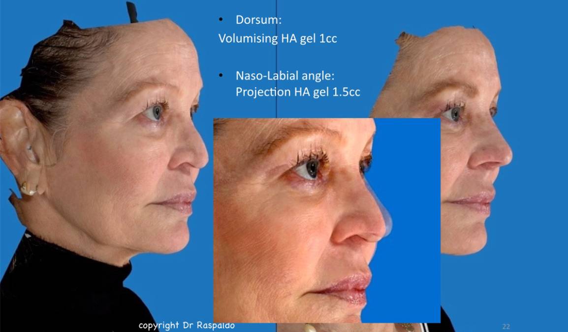 高清图解!注射隆鼻切开给你看,你敢吗?(医图慎入)