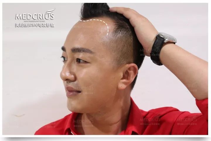 征集脱发、秃顶等毛发缺失患者,享免费植发!|植