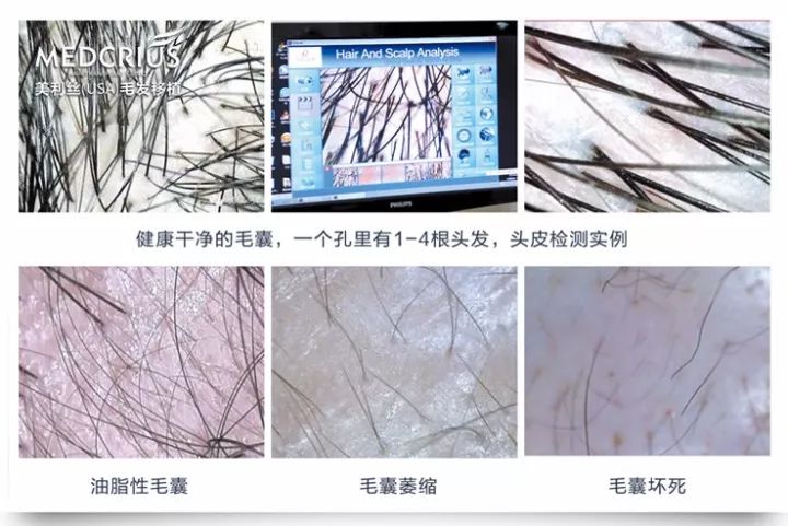 征集脱发、秃顶等毛发缺失患者,享免费植发!|植